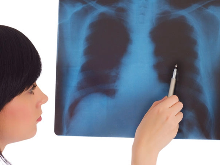 o femeie care se uită la o radiografie pulmonară