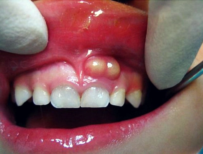 abces dentar