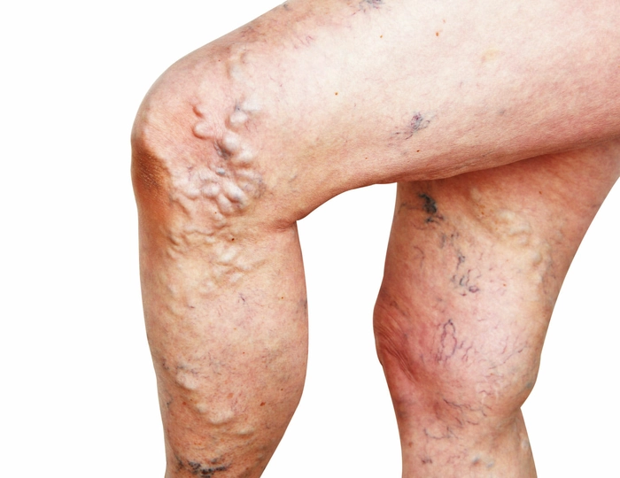 picioarele unei persoane care sufera de tromboza