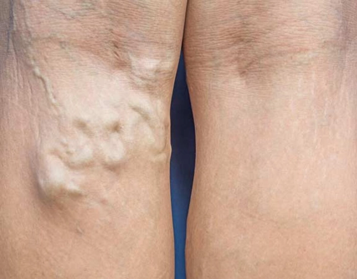 persoana care are vasele de sange la picioare infundate
