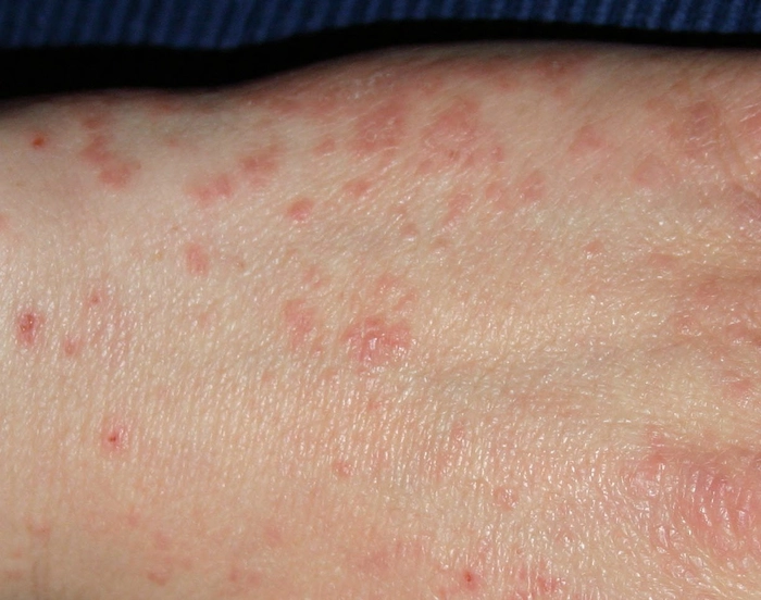 persoana care sufera de scabie