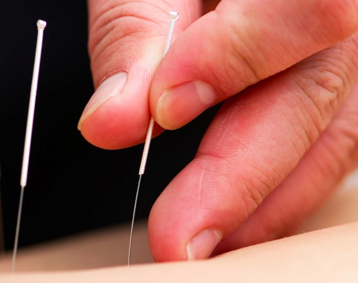 poză cu metoda acupunctură