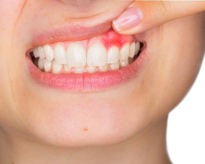 grafica persoana care sufera de abces dentar