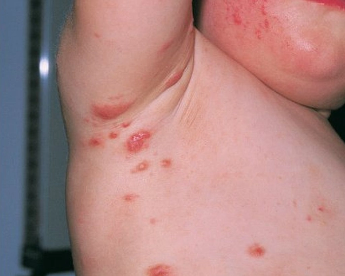persoana care sufera de scabie