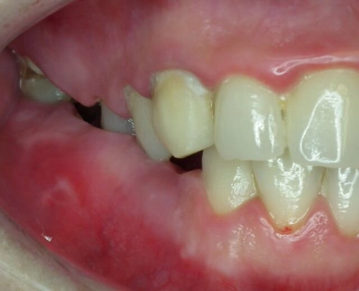 abces dentar