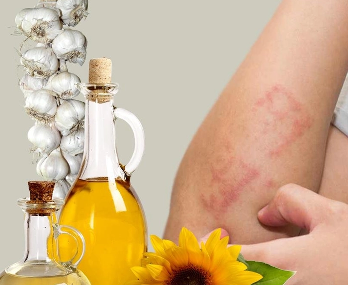 persoana care sufera de raie si se scarpina langa usturoi si alte remedii