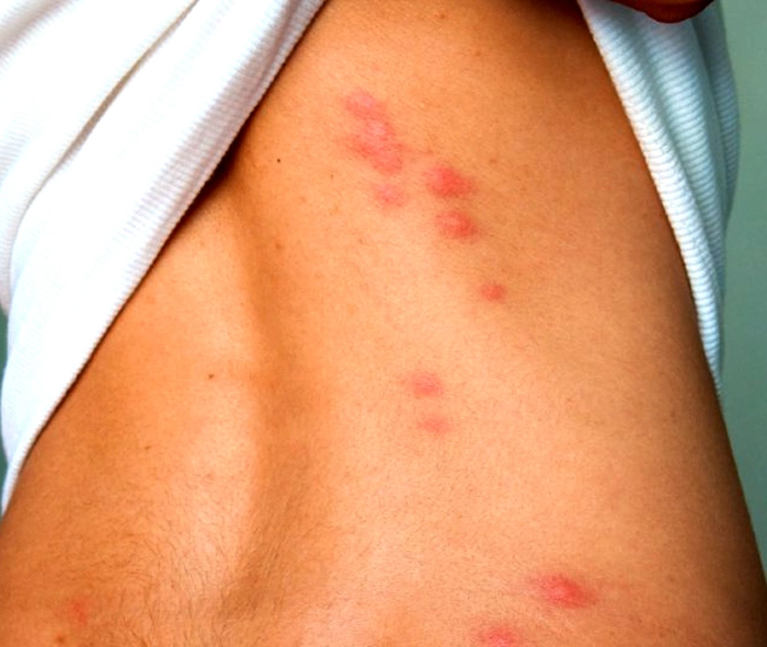 spatele unei persoane plin de muscaturi de insecte