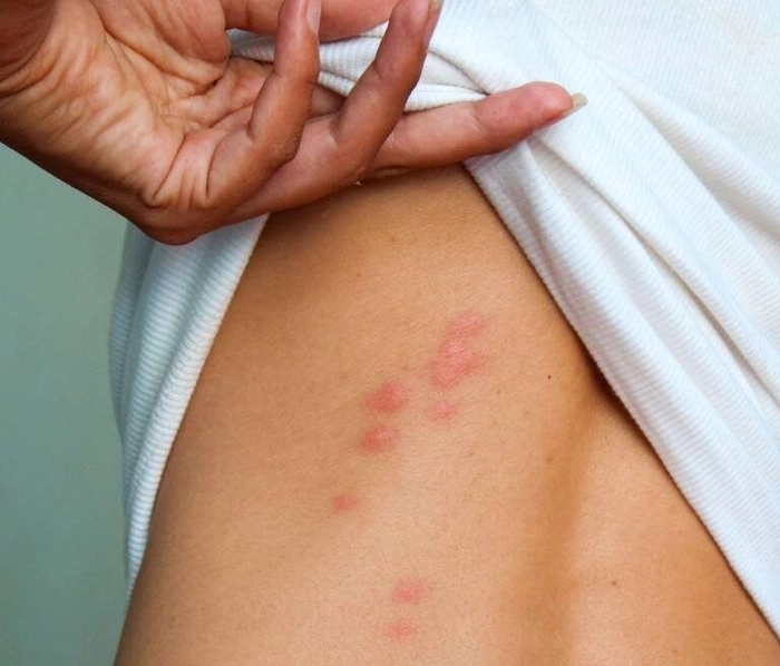 persoana care are mai multe ciupituri de purice pe spate