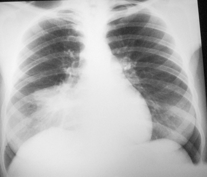 o radiografie pulmonară, care relevă o pneumonie