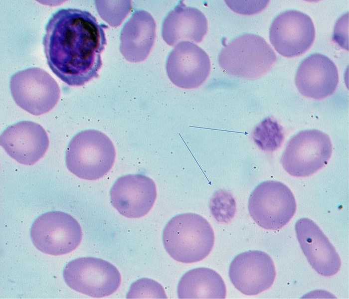 purpura trombocitopenică idiopatică la microscop