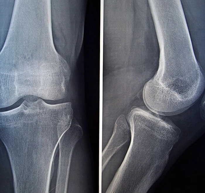 radiografie la genunchi