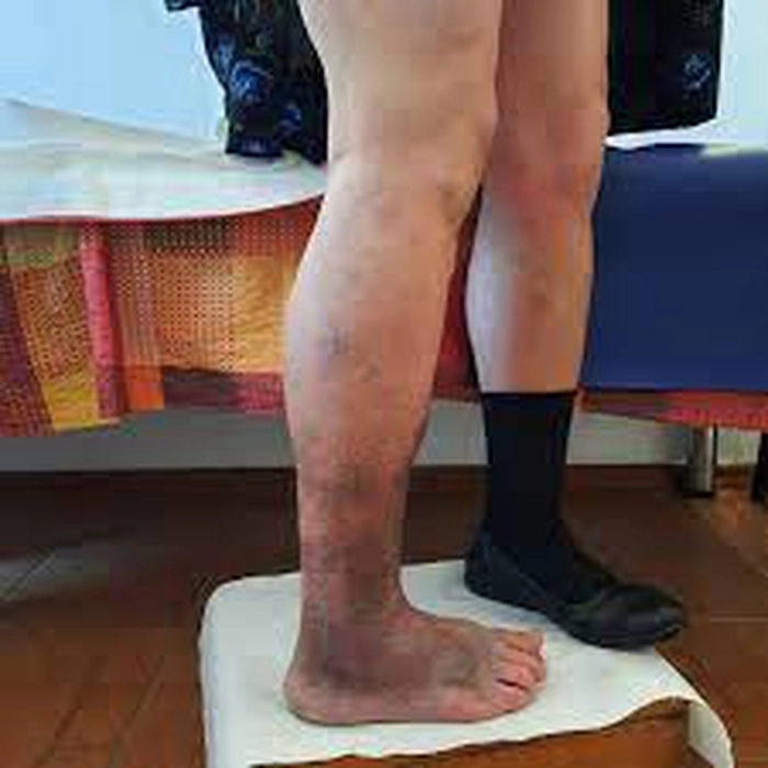 persoană care are ulcer varicos