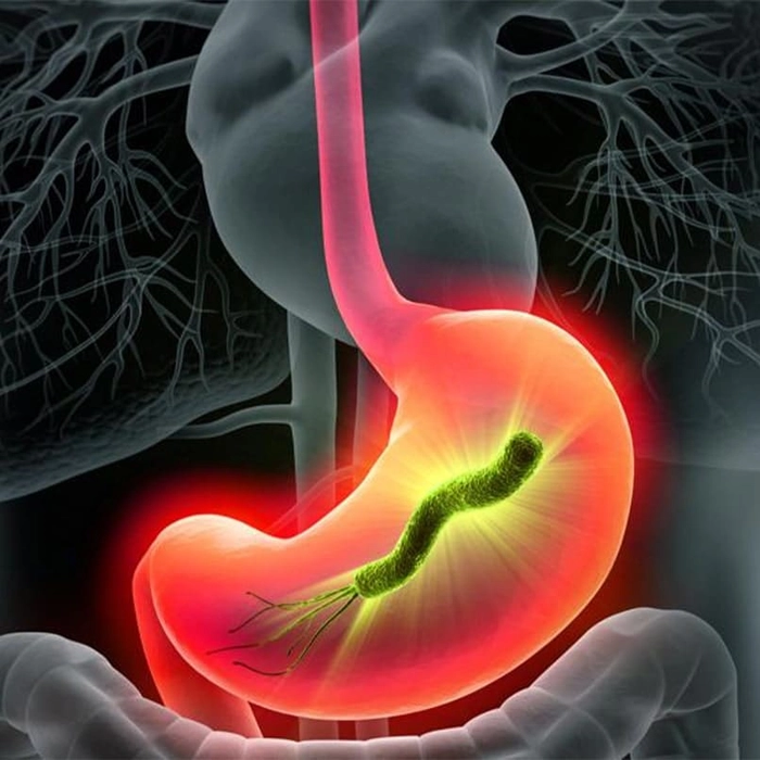 stomac inflamat de catre bacteria helicobacter pylori