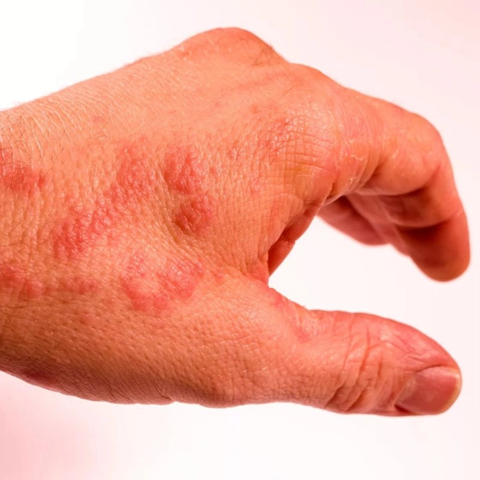 mainele unei persoane care sufera de eczema