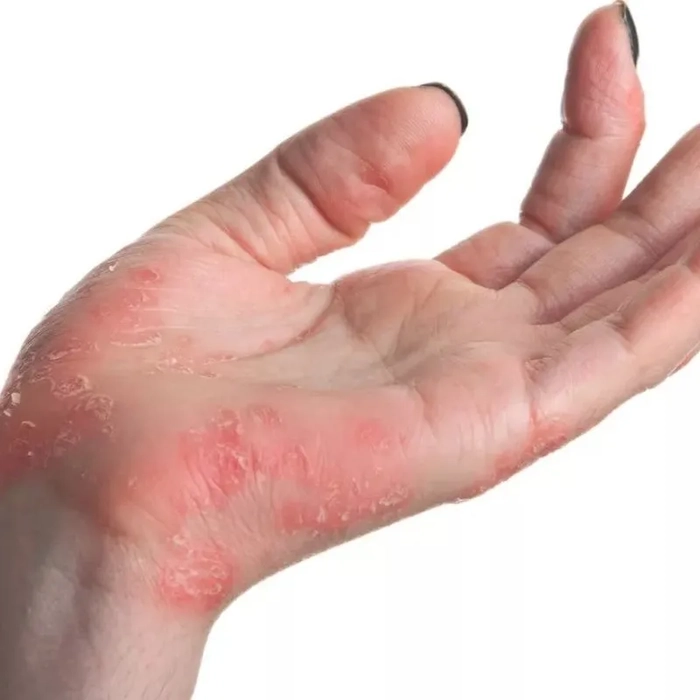 persoana care sufera de eczeme pe maini