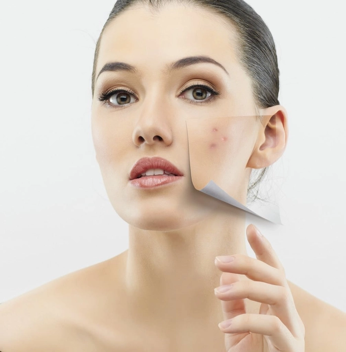 persoana care sufera de acnee 