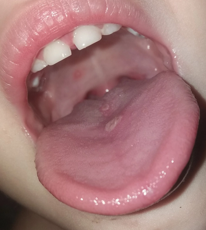 gatul unei persoane care sufera de herpangina