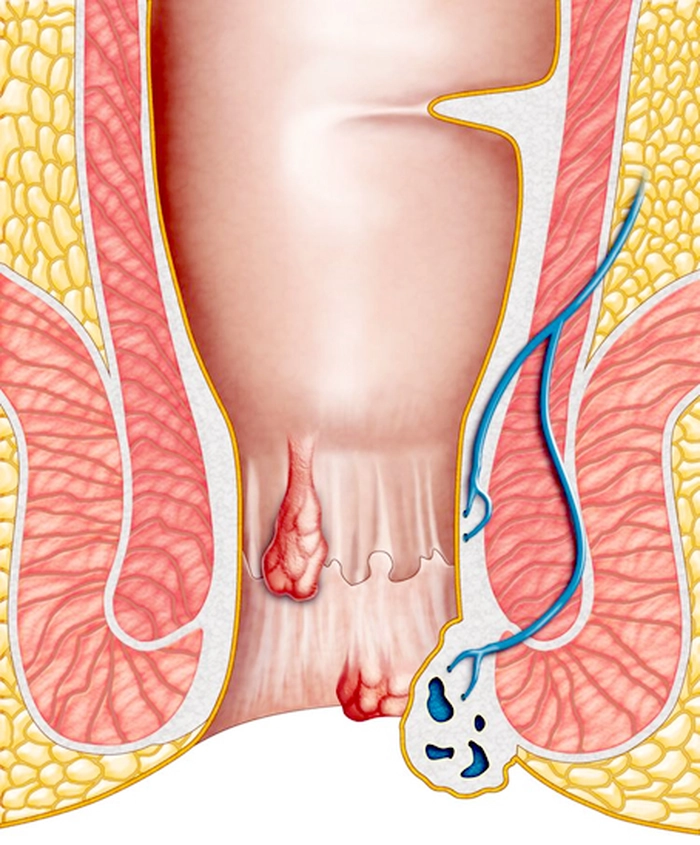 grafic in care este reprezentat cum hemoroizii afecteaza intestinele