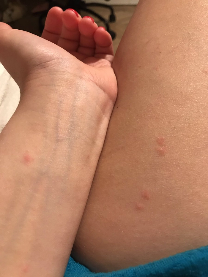 persoana care are ciupituri de purice pe maini si picioare