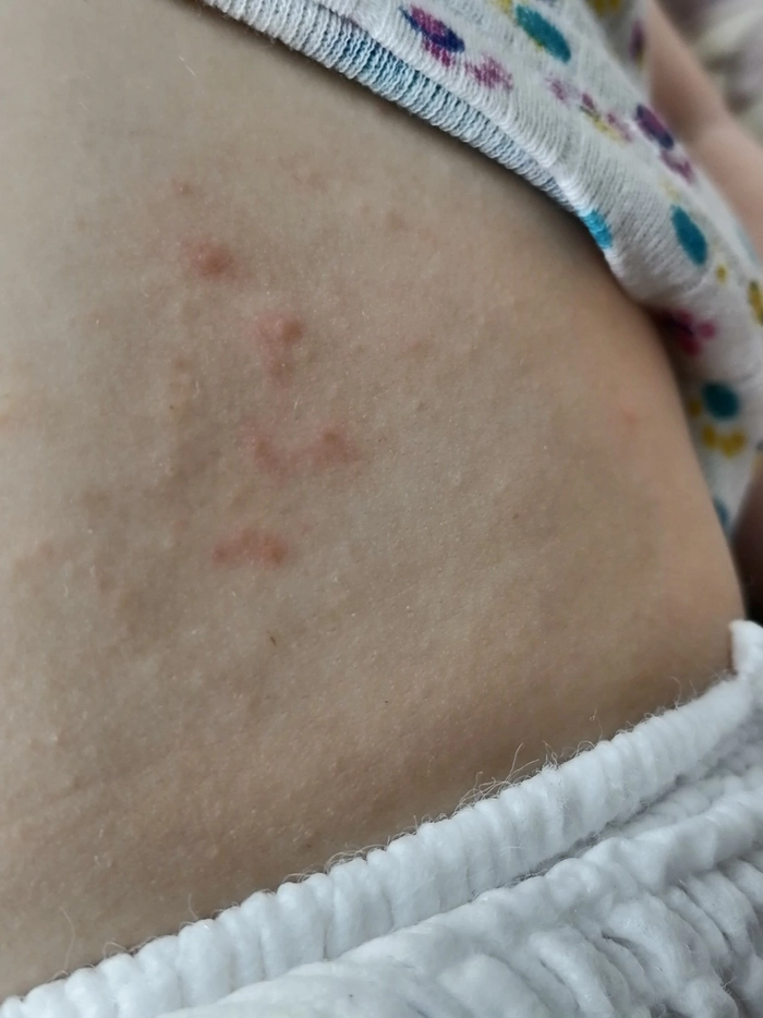 burta unui copil acoperita cu eruptii cutanate