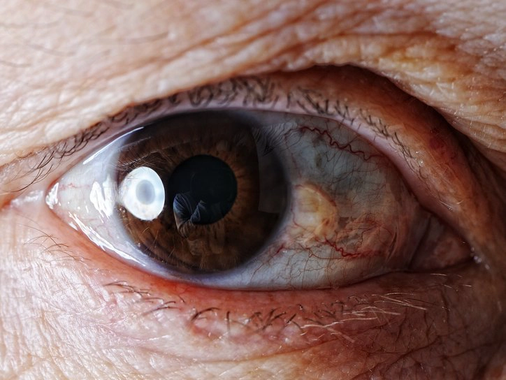 ochiul afectat de o boala a unei persoane