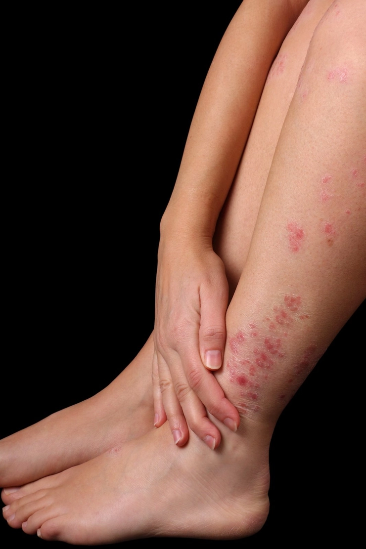 persoana care sufera de eczeme pe picioare
