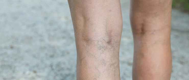 picioarele unei femei care sufera de trombofilie ereditara