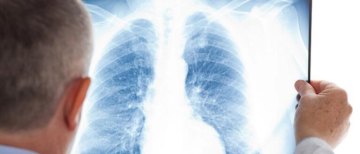 medic care se uită pe o radiografie pulmonară