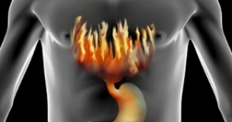 grafica arsuri la nivelul pieptului provocate de refluxul gastroesofagian