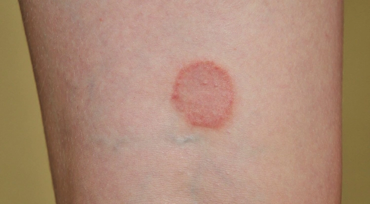 eruptie cutanata pe pielea unei persoane