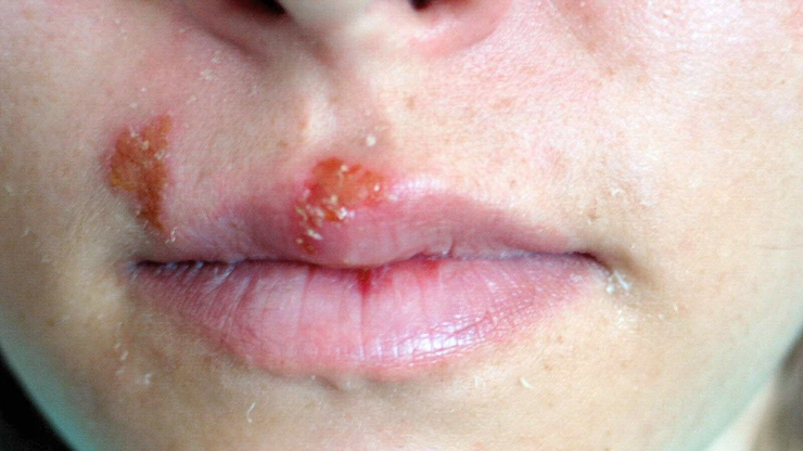 persoană care are herpes bucal