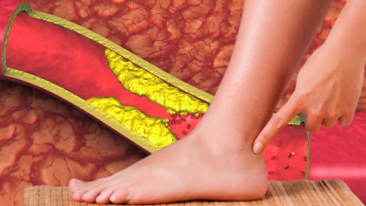 grafica piciorul unui om langa o vena prin care trece sangele si colesterolul