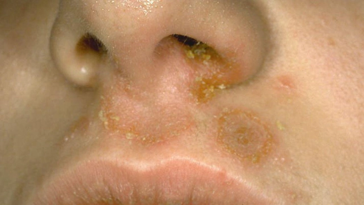 infectie cu stafiloco auriu în nas