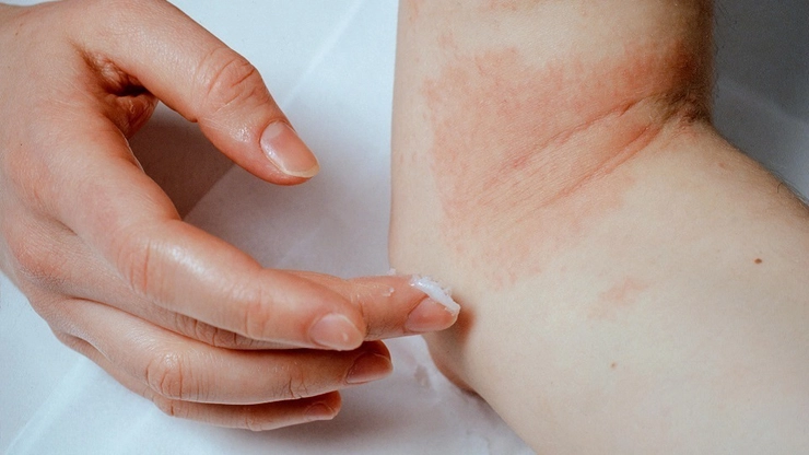 persoana care aplica o crema pe bratul afectat de o boala de piele