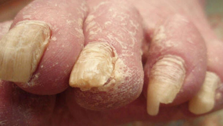 degetele de la picioare ale unei persoane care sufera de micoza unghiilor