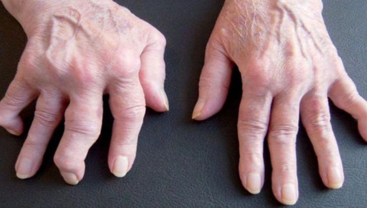 mâini afectate de reumatism
