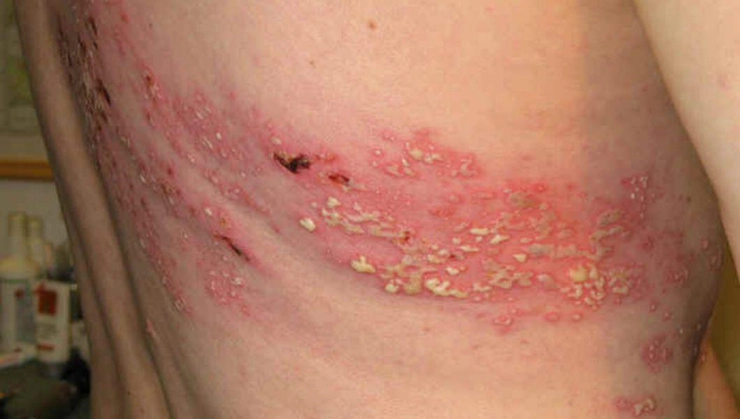 eruptie cutanata pe pielea spatelui a unei persoane