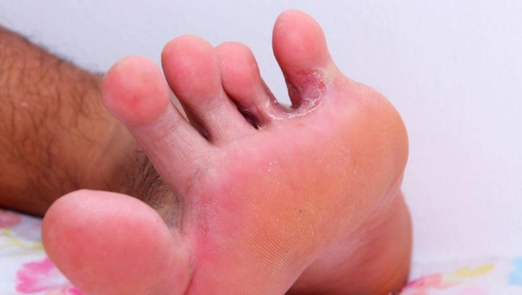 micoză pe pielea piciorului