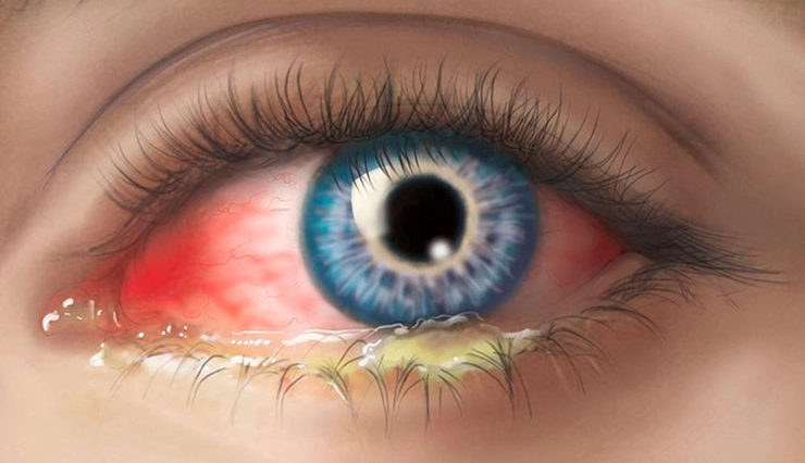 grafica secretie galbena din ochiul inrosit a unei persoane