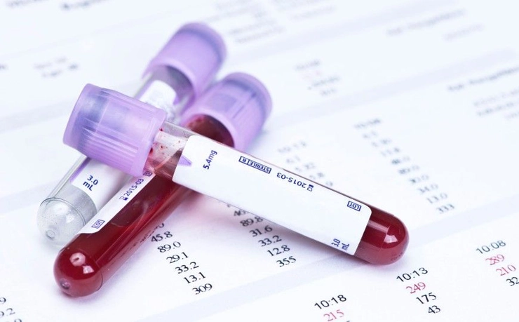 trei eprubete cu proba de sange pe rezultatul unor analize