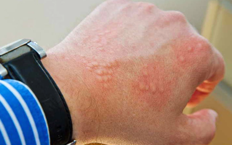 manifestarea alergiei de la frig pe mana unei persoane