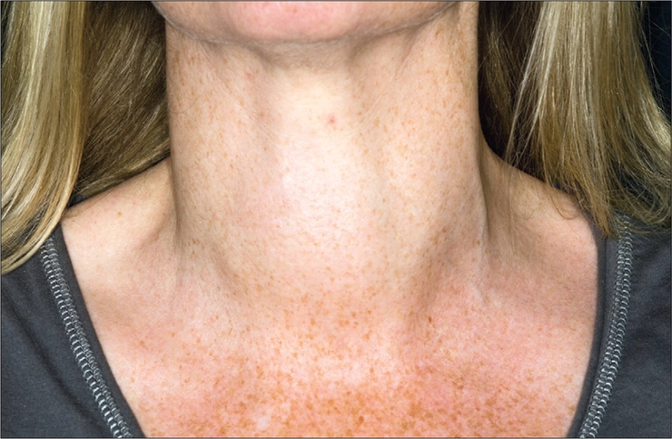 persoana cu o inflamare usoara a tiroidei