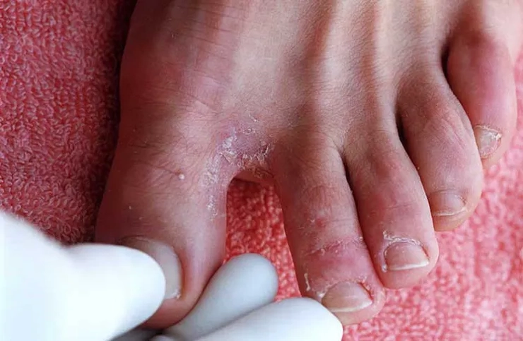 medic care controleaza degetele de la picioare ale unei persoane afectate de ciuperca