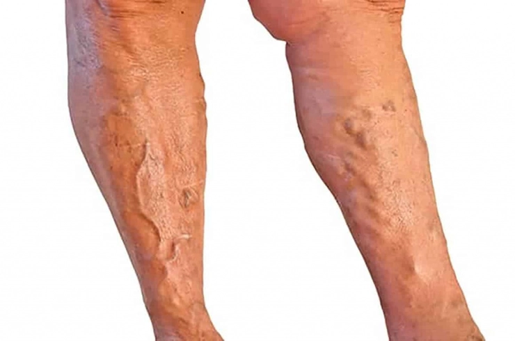 picioarele unei persoane care sufera de tromboza