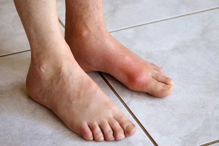 piciorul unei persoane afectat de guta