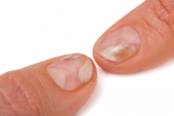 unghiile unei persoane afectate de ciuperca