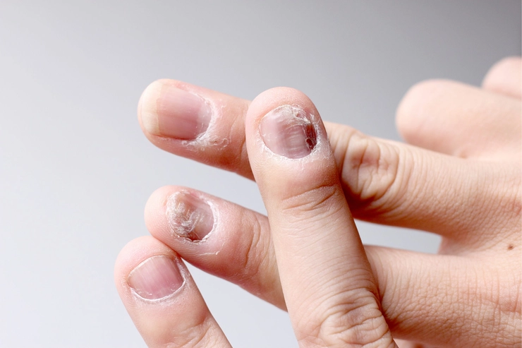 unghiile unei persoane afectate de ciuperca