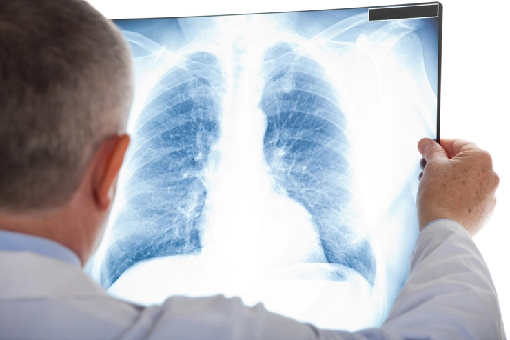 un medic care se uită pe o radiografie la plămâni
