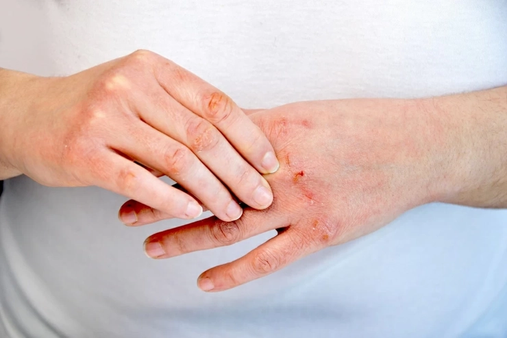 mainele unei persoane care sufera de dermatita atopica