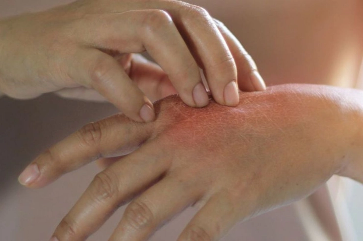 grafica persoana care sufera de eczeme pe maini